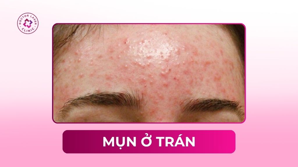 Mọc mụn ở trán: Nguyên nhân, cách điều trị và phòng ngừa