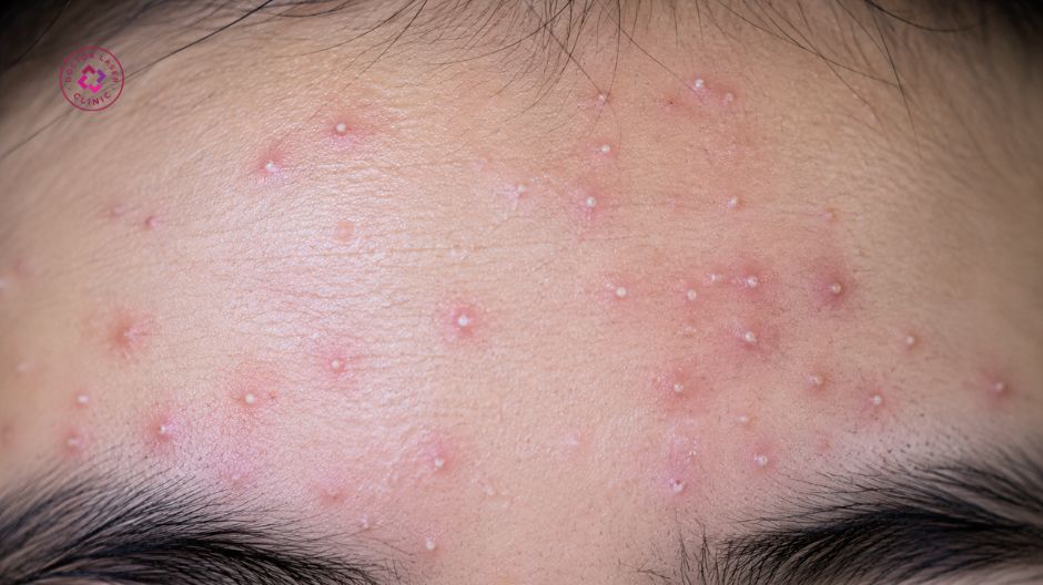 mụn đầu trắng là gì