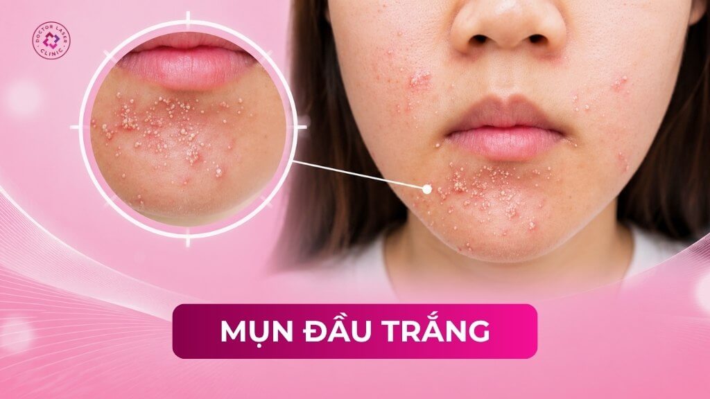 Mụn đầu trắng: Nguyên nhân, dấu hiệu, vị trí và cách phòng ngừa