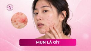 mụn là gì mụn là gì