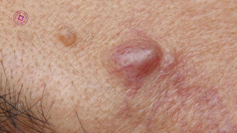 mụn nang viêm nặng dưới da