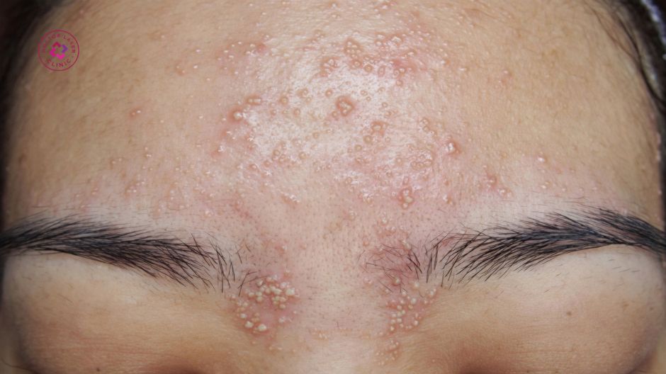 mụn nước nhỏ li ti sau peel da