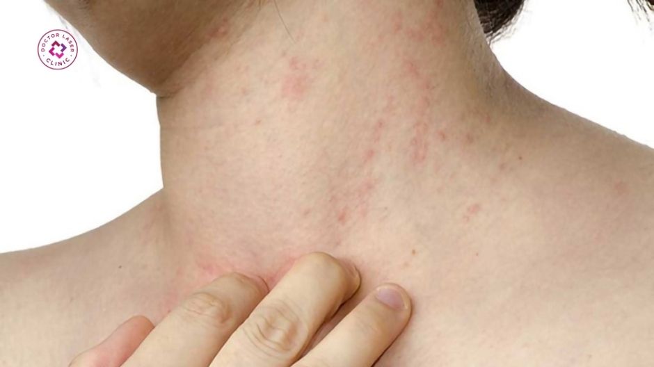 mụn ở cổ là gì