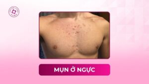 mụn ở ngực mụn ở ngực