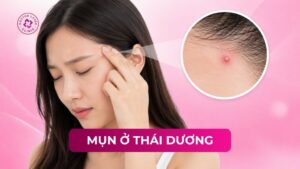 mụn ở thá dương mụn ở thá dương