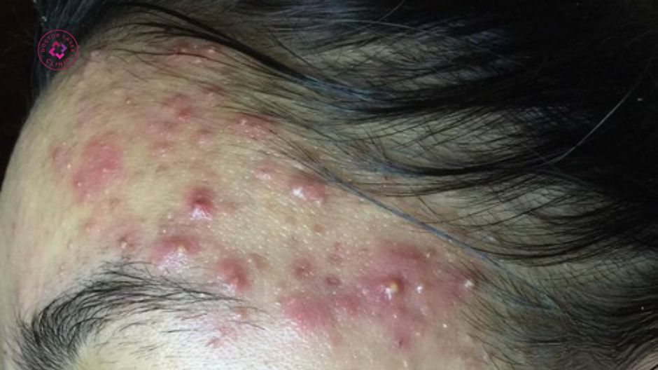 mụn ở thái dương viêm nặng cần chẩn đoán