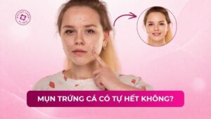 mụn trứng cá có tự hết không