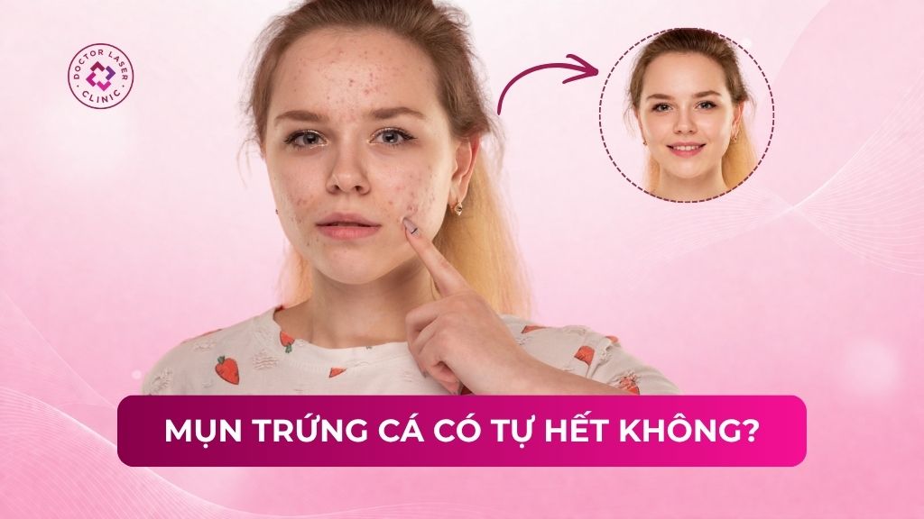 Mụn trứng cá có tự hết không? Thời điểm và phương pháp điều trị