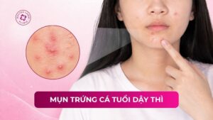 mụn trứng cá tuổi dậy thì