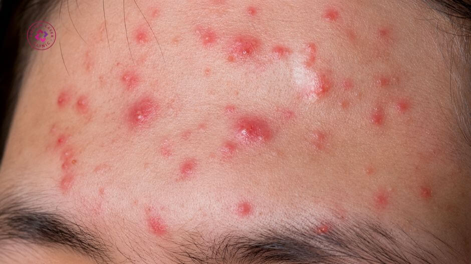 mụn viêm đỏ trên mặt