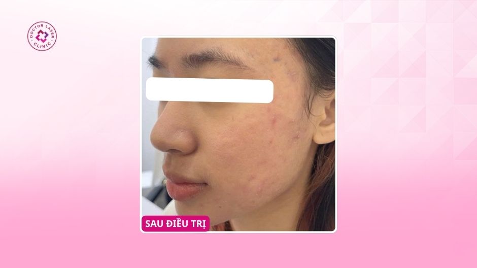 mụn viêm rỗ thâm sau 10 ngày điều trị