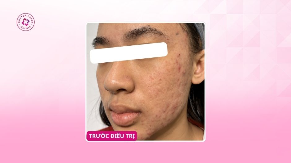 mụn viêm rỗ thâm trước điều trị