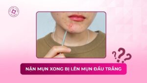 nặn mụn xong bị lên mụn đầu trắng là do đâu hướng dẫn xử lý