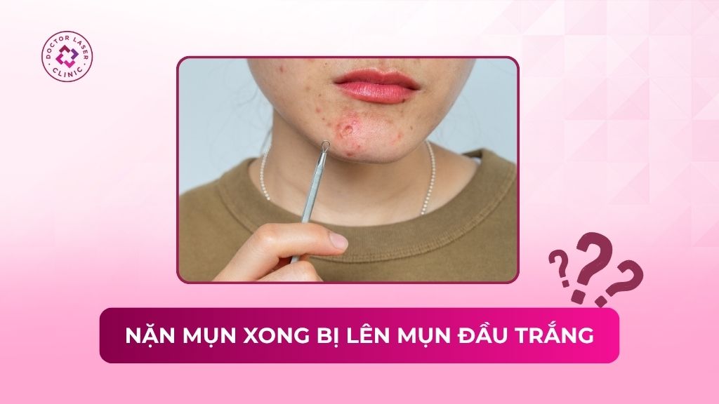 Nặn mụn xong bị lên mụn đầu trắng là do đâu? Hướng dẫn xử lý