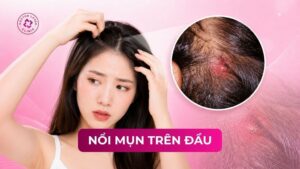 nổi mụn trên đầu