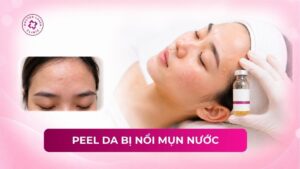 peel da bị nổi mụn nước