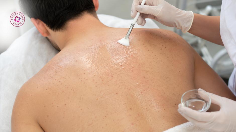peel lưng mụn ẩn mụn đầu đen bít tắc