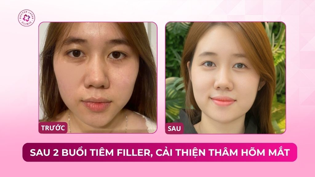 sau 2 buổi tiêm filler cải thiện thâm hõm mắt