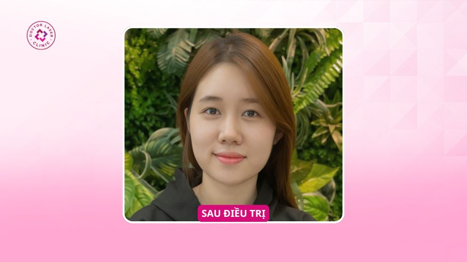 sau điều trị hõm thâm mắt
