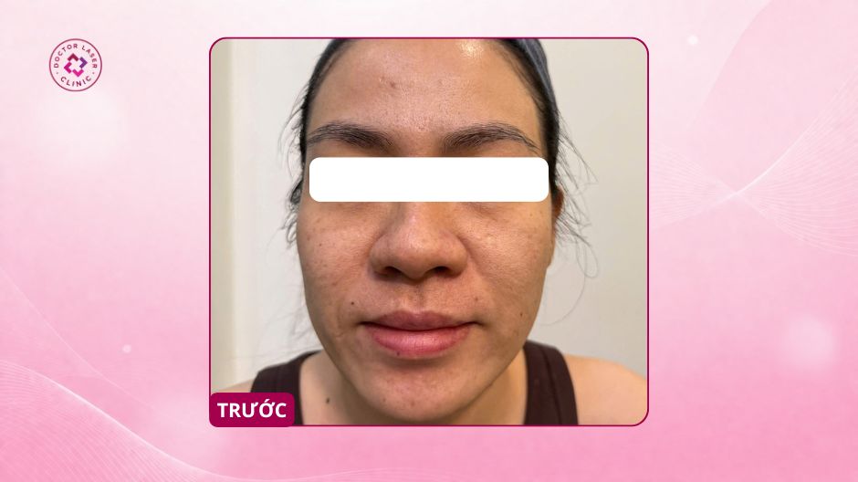 sẹo rỗ trước điều trị chị t bình thạnh