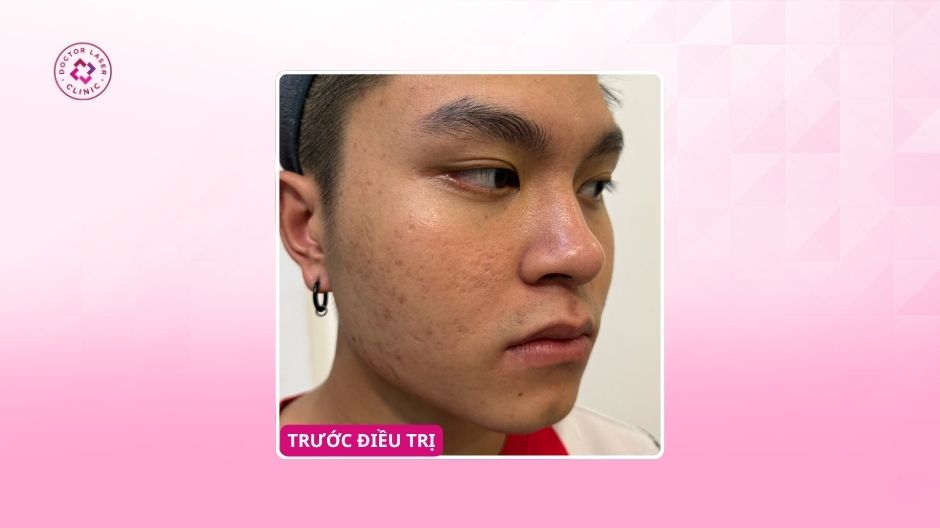sẹo rỗ tuổi dậy thì trước khi điều trị