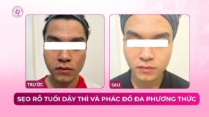 sẹo rỗ tuổi dậy thì và phác đồ đa phương thức sẹo rỗ tuổi dậy thì và phác đồ đa phương thức