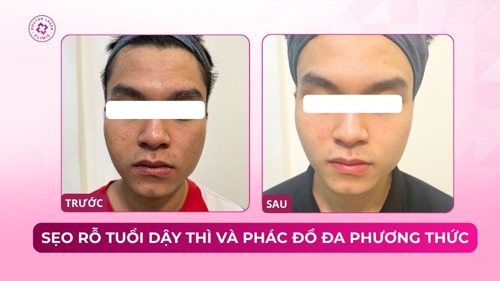 sẹo rỗ tuổi dậy thì và phác đồ đa phương thức