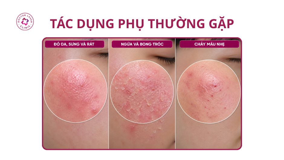 tác dụng phụ thường gặp sau laser trị mụn