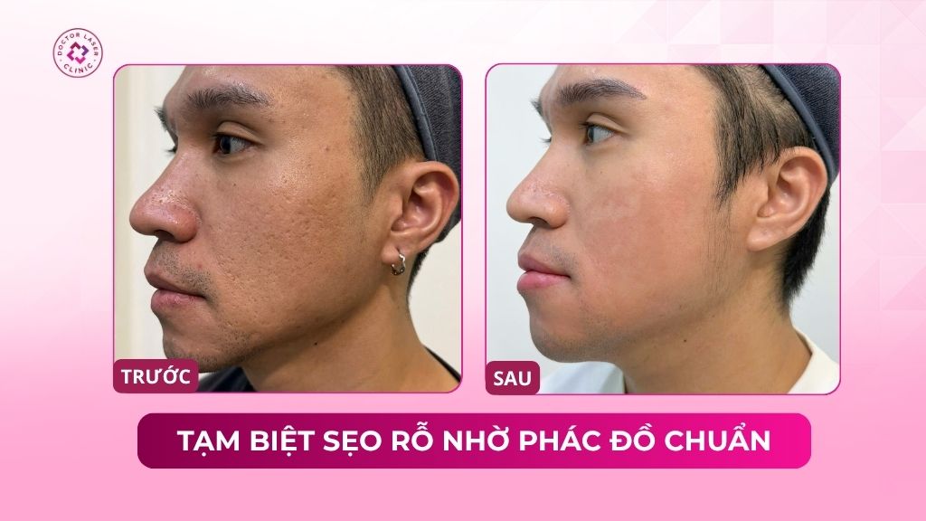tạm biệt sẹo rỗ nhờ phác đồ chuẩn