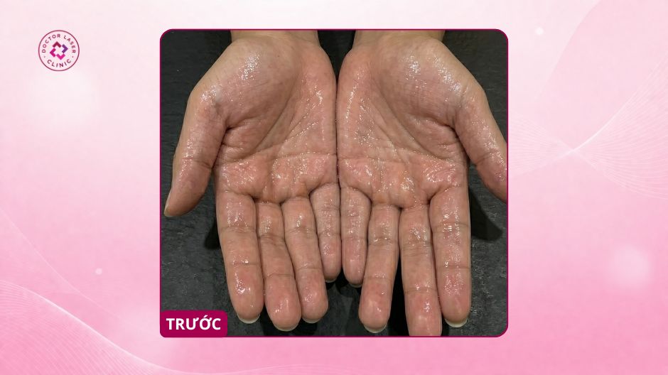 tăng tiết mồ hôi tay trước điều trị
