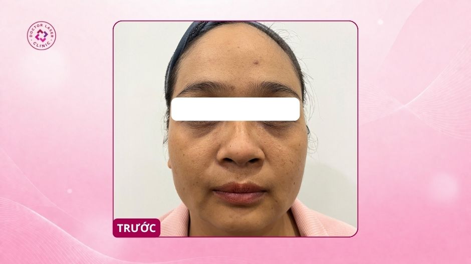 thăm mắt và mắt trũng trước khi tiêm ha vùng mắt