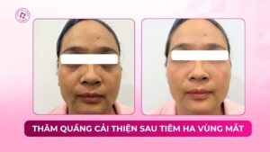 thâm quầng cải thiện sau tiêm ha vùng mắt