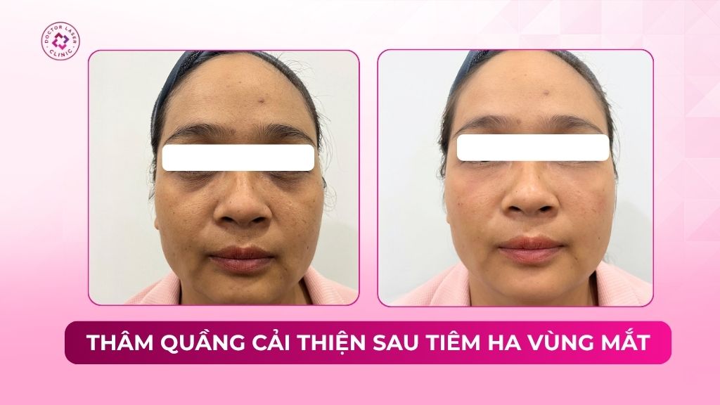 thâm quầng cải thiện sau tiêm ha vùng mắt
