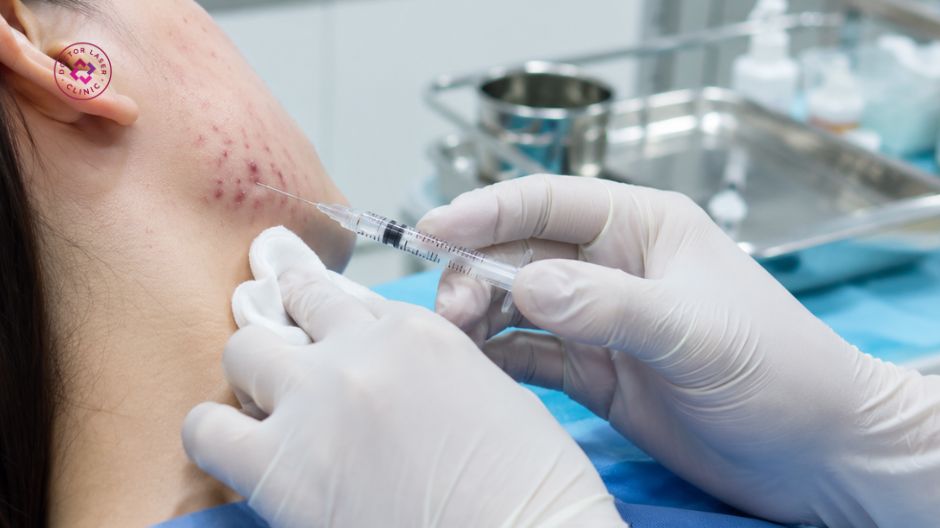tiêm corticoid trị mụn ở quai hàm
