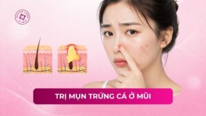 trị mụn trứng cá ở mũi