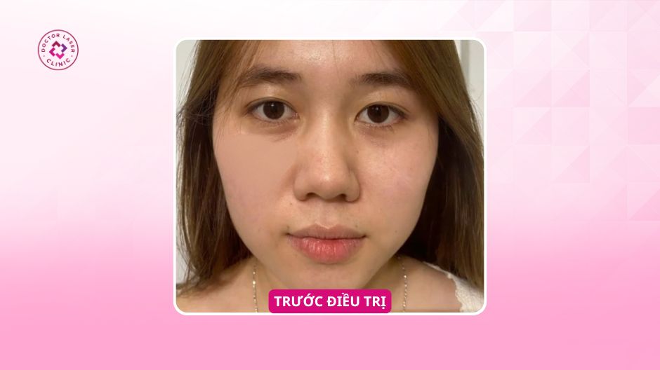 trước điều trị thâm hõm mắt
