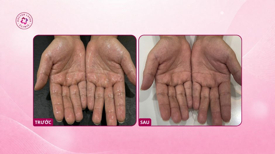 trước sau điều trị đổ mồ hôi tay