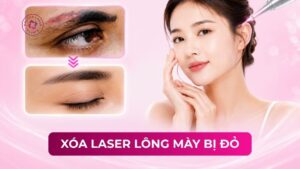 xoá laser lông mày bị đỏ