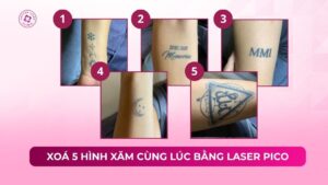 xoá nhiều hình xăm cùng lúc bằng laser pico