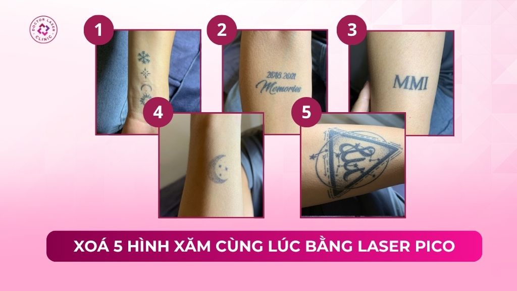 xoá nhiều hình xăm cùng lúc bằng laser pico