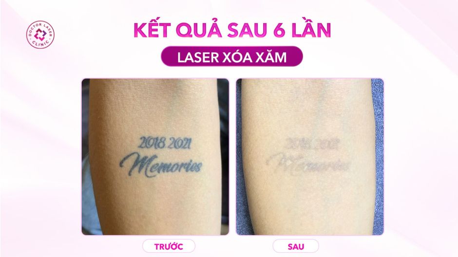 xoá xăm chữ bằng laser pico sau 6 lần