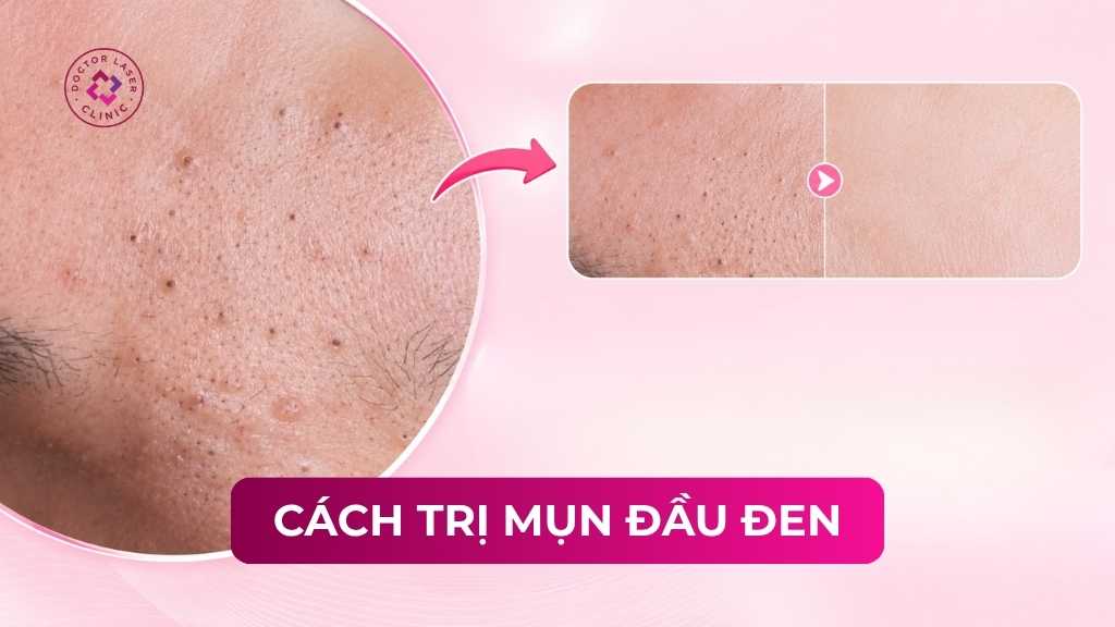 cách trị mụn đầu đen