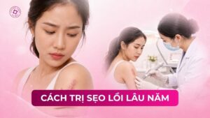 cách trị sẹo lồi lâu năm