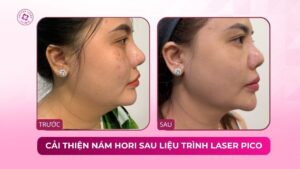 cải thiện nám hori sau liệu trình laser pico