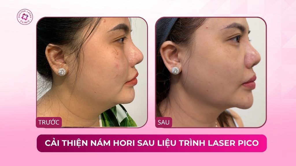 cải thiện nám hori sau liệu trình laser pico