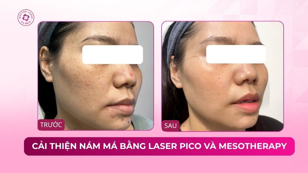cải thiện nám má bằng laser pico và mesotherapy