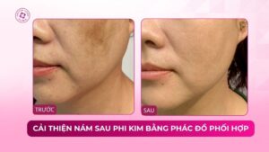 cải thiện nám sau phi kim bằng phác đồ phối hợp