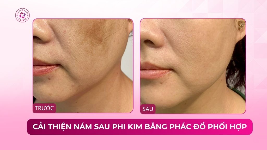 cải thiện nám sau phi kim bằng phác đồ phối hợp