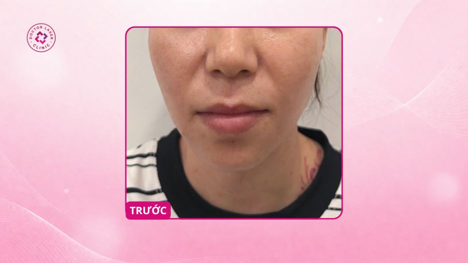 cằm lẹm trước khi tiêm filler tại doctor laser