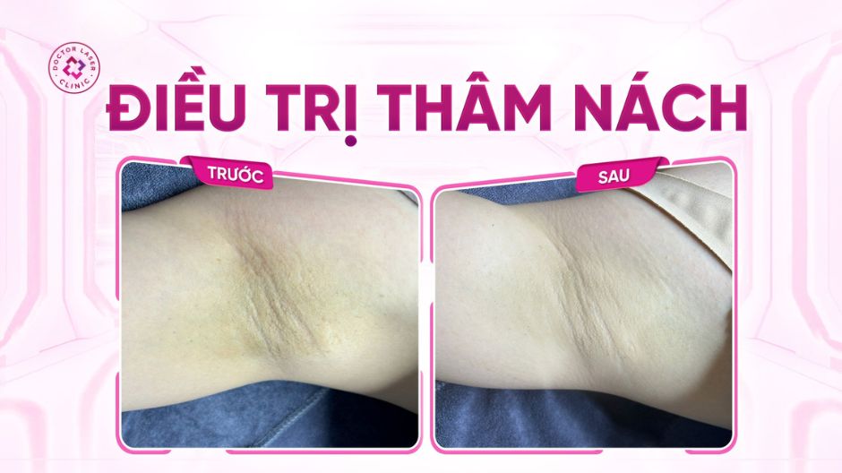 case thực tế điều trị thâm nách